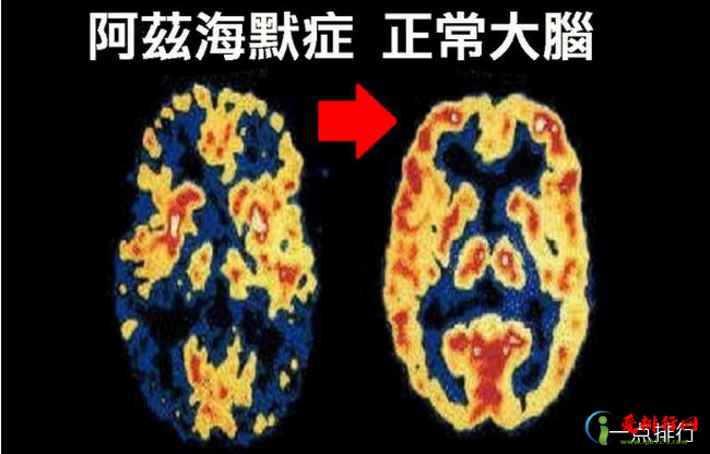 世界首款阿兹海默药问世 人类不再惧怕脑海中的橡皮擦